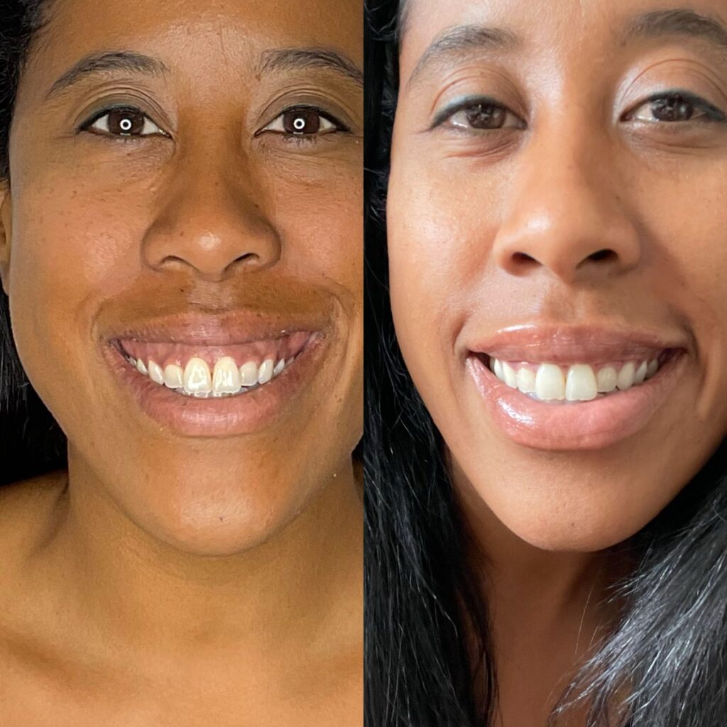 Aspen Elevated Before and After photos