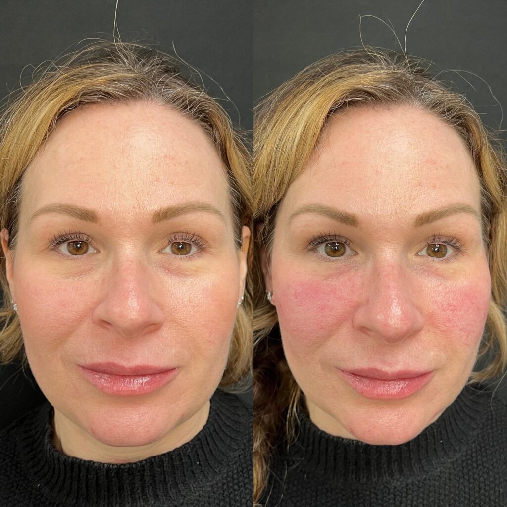 Aspen Elevated Before and After photos