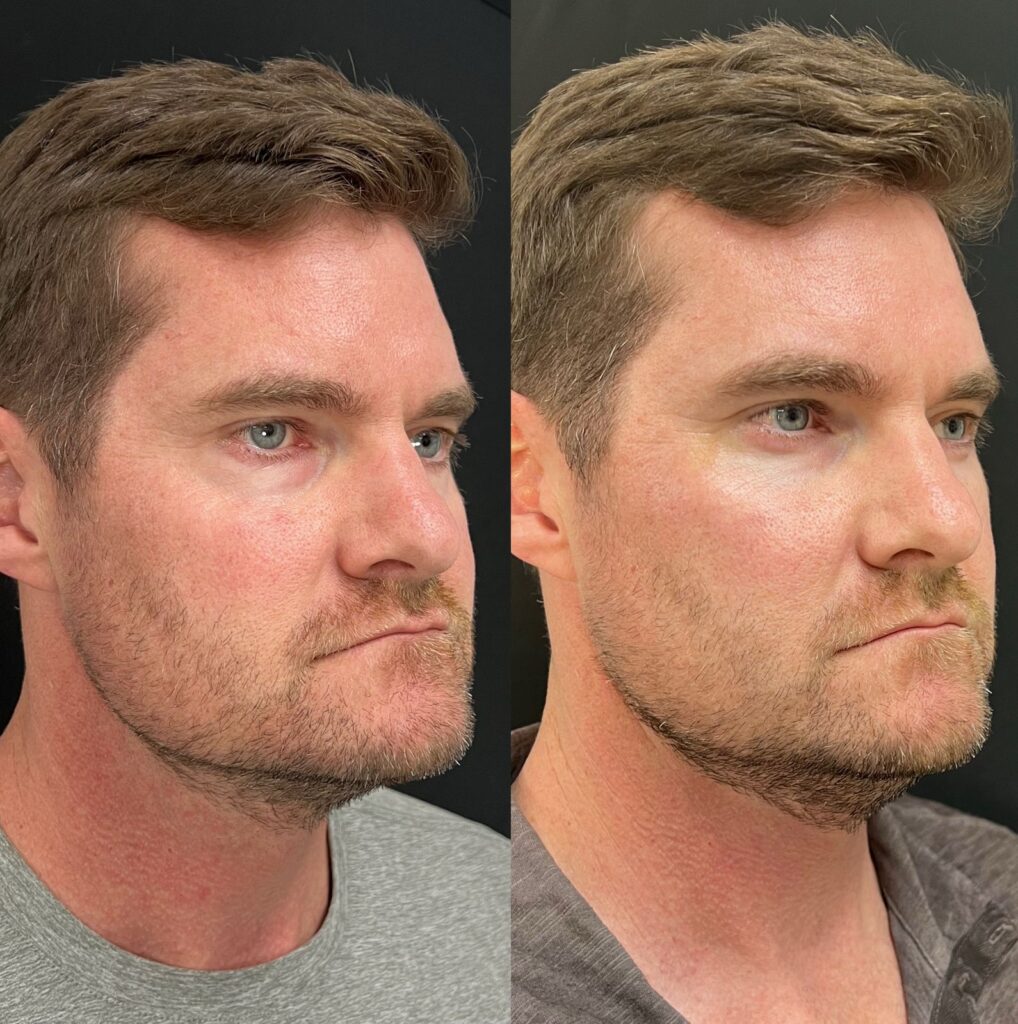 Aspen Elevated Before and After photos