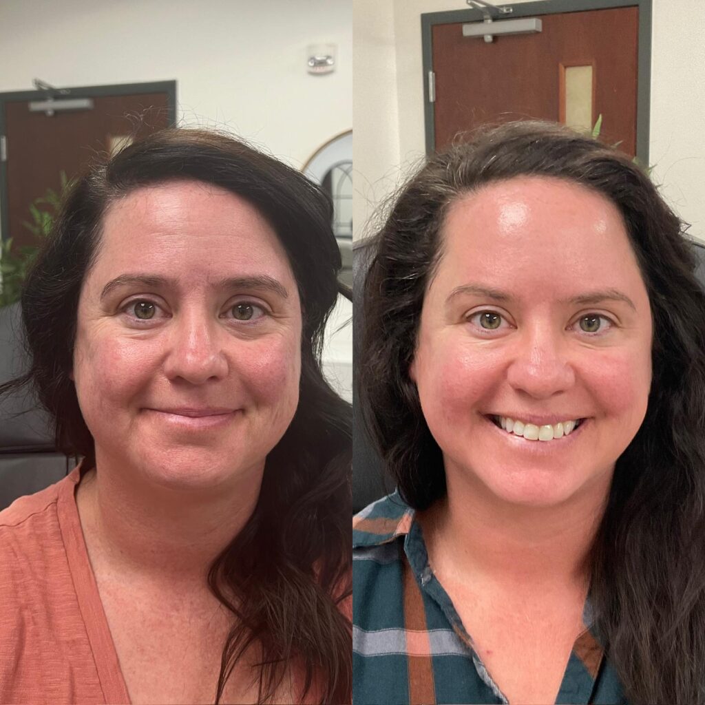 Aspen Elevated Before and After photos