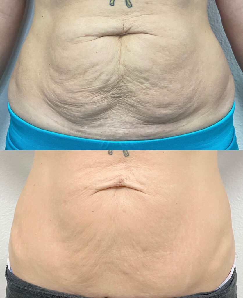 Aspen Elevated Before and After photos
