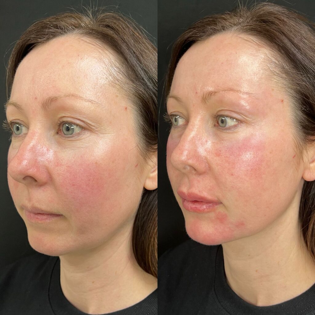Aspen Elevated Before and After photos