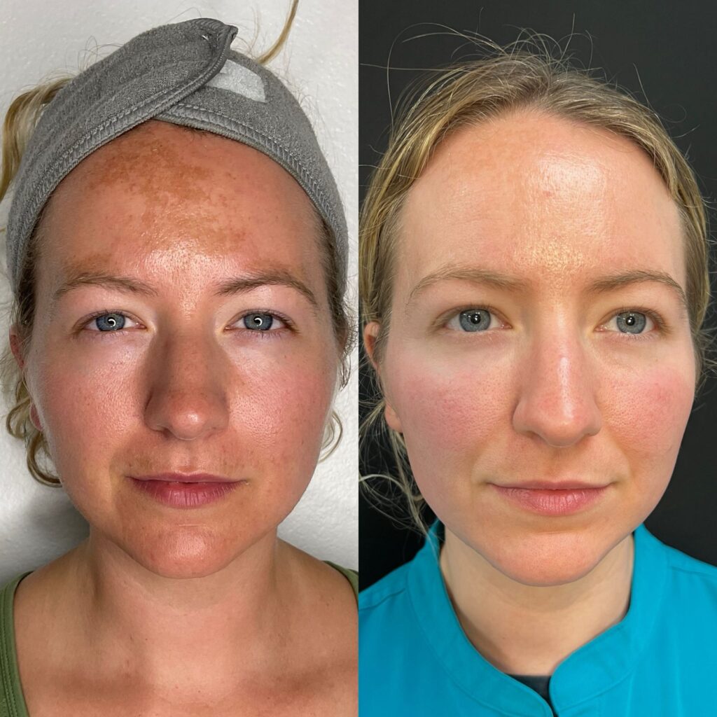 Aspen Elevated Before and After photos