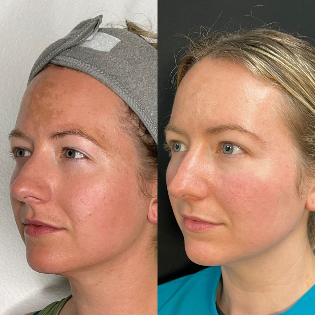 Aspen Elevated Before and After photos
