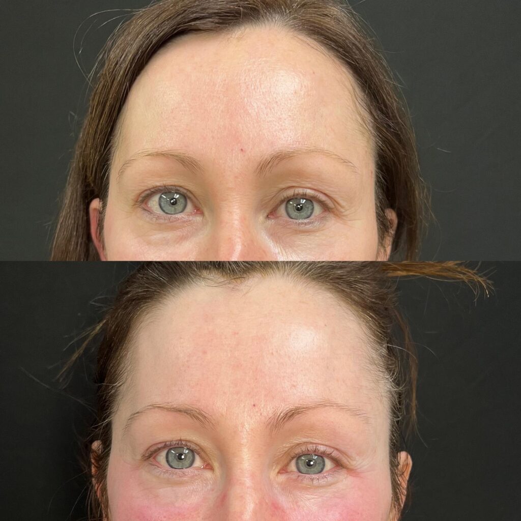 Aspen Elevated Before and After photos