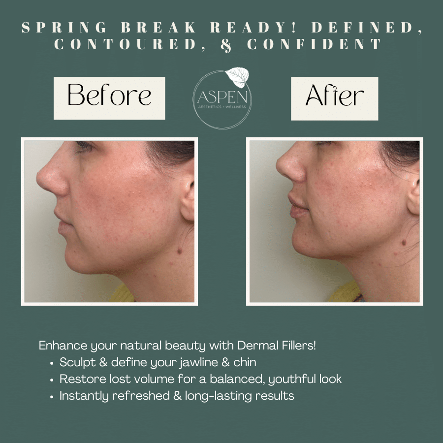 Spring Break Ready Botox Fillers for a Fresh Youthful Look