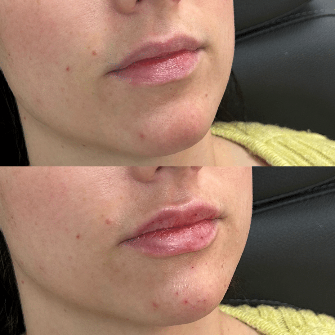 Natural-Looking Lip Filler: How to Avoid an Overdone Look