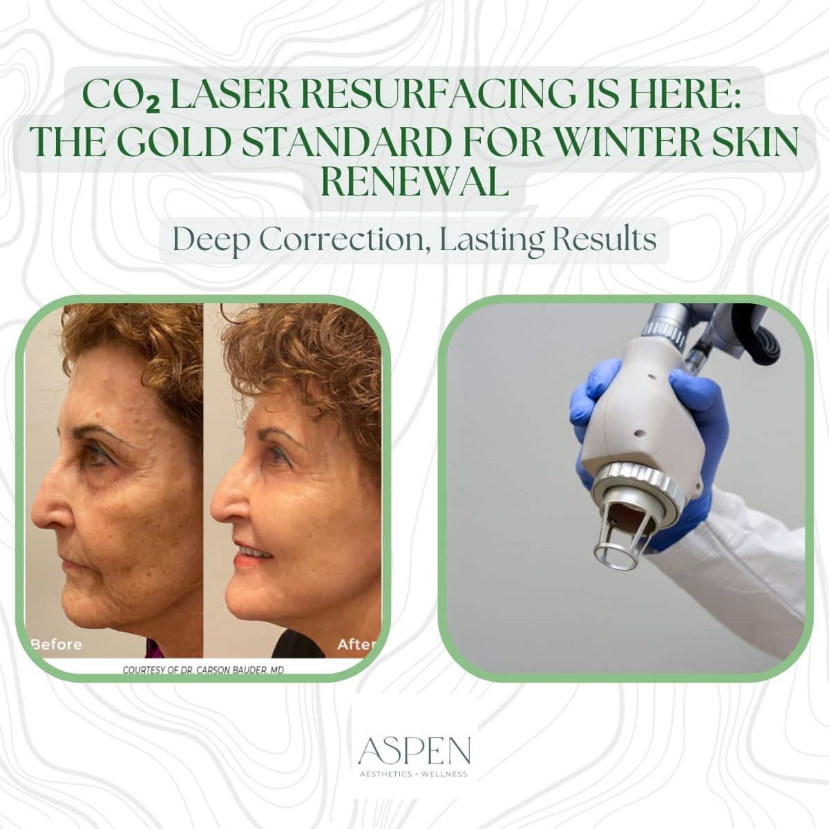 CO₂ laser resurfacing colorado springs