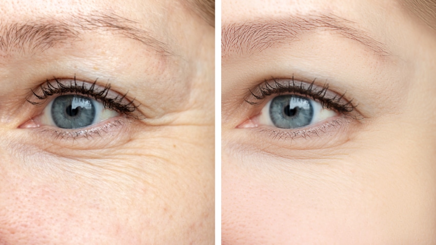 Botox in Colorado Springs: Cost, Treatment Areas, and What to Know Before You Book 2 Botox treatment areas Colorado Springs including forehead frown lines and crow's feet